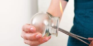 What Is Cupping Therapy?
