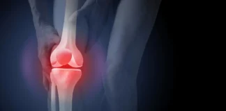 The surprising reason x-rays can push arthritis patients toward surgery
